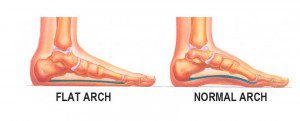 Flat Feet Treatment - California Chiropractic Center - Dubai, UAE