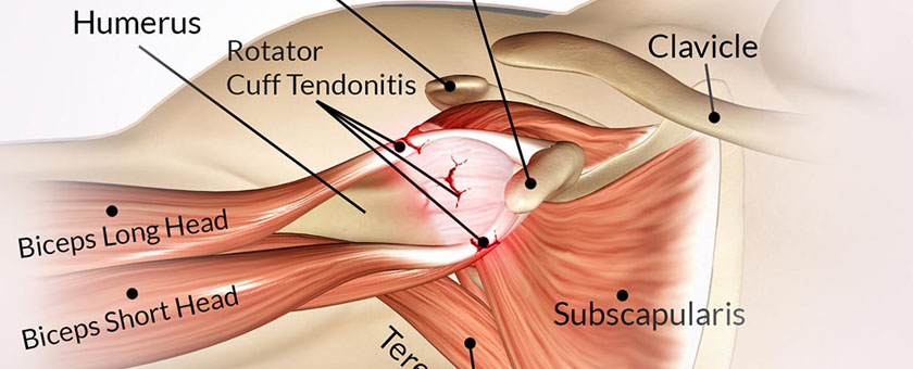 Rotator Cuff Tendon Calcific Tendinitis Treatment Algorithm For Primary 